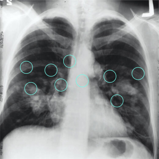 Detecting pneumonia in x-ray images